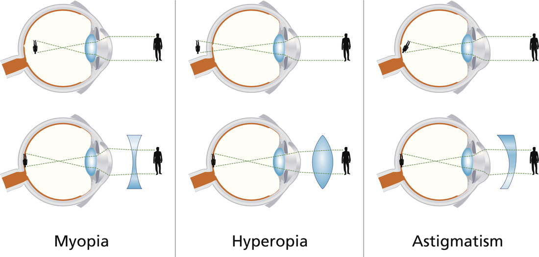 Hyperopia Farsighted Kindred Optics